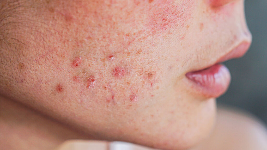 Tools zur Behandlung von Mitessern und Akne - diese Geräte helfen gegen  Hautunreinheiten